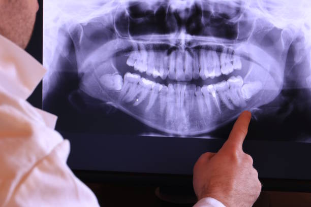 Best Knocked-Out Tooth (Avulsed Tooth) Treatment in Issaquah, WA