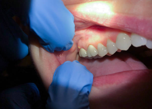 Best Broken or Chipped Tooth Repair in Issaquah, WA